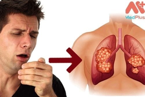 Nguyên nhân gây ung thư phổi
