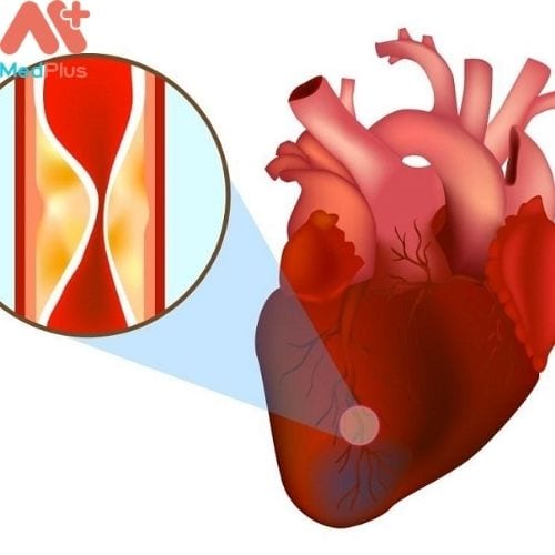 Nhồi máu cơ tim cấp tính là một trong những nguyên nhân hàng đầu gây tử vong