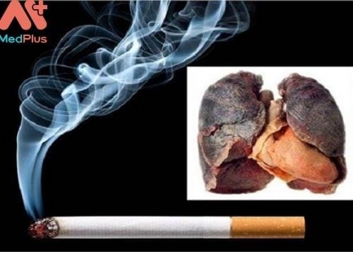 Thuốc lá là nguyên nhân hàng đầu gây ung thư phổi