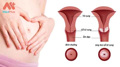 Tầm soát ung thư cổ tử cung