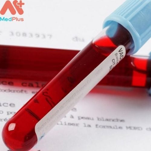 Xét nghiệm PLT là xét nghiệm đếm số lượng tiểu cầu trong máu