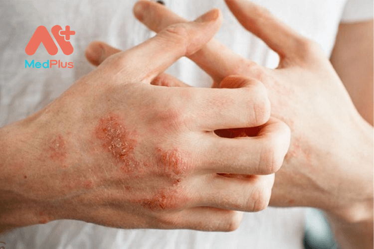 bệnh chàm Eczema là gì