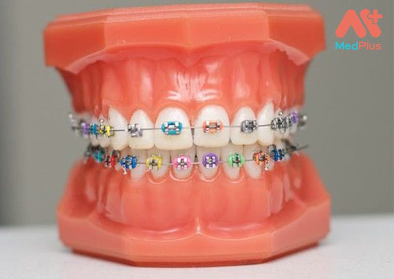 Niềng răng tăng trưởng cho trẻ em tại Bệnh viện răng hàm mặt SG