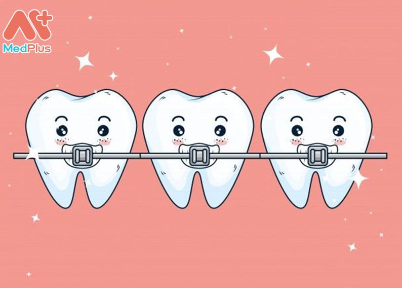 Niềng răng có tác dụng gì?