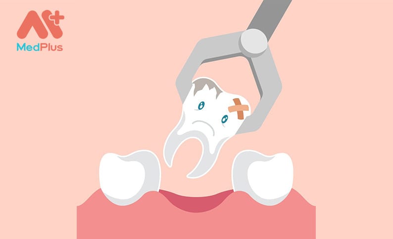 5+ Lưu ý khi nhổ răng khôn tại Bệnh viện răng hàm mặt TP.HCM