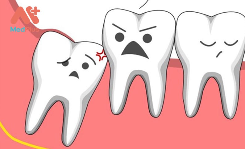 Nhổ răng khôn tại Bệnh viện răng hàm mặt TP.HCM