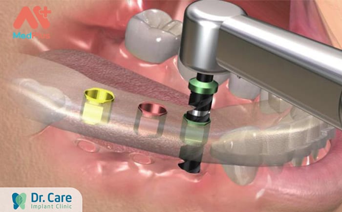 Trồng răng implant tại Nha khoa Dr Care