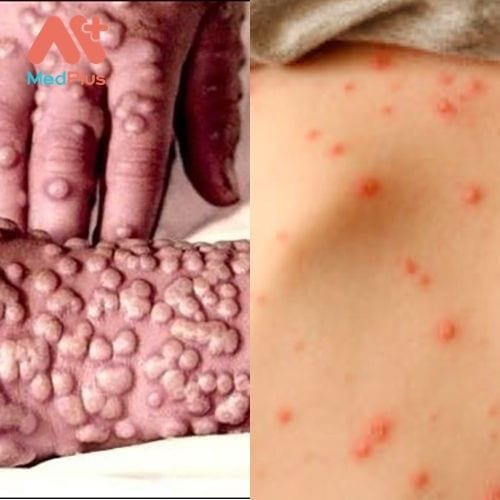Bệnh đậu mùa do virus đậu mùa gây ra
