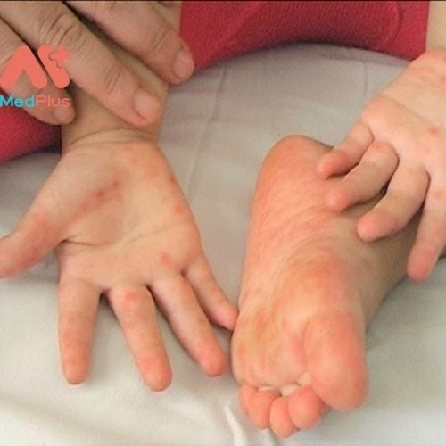 Bệnh tay chân miệng - một bệnh nhiễm vi rút nhẹ, dễ lây lan thường gặp ở trẻ nhỏ