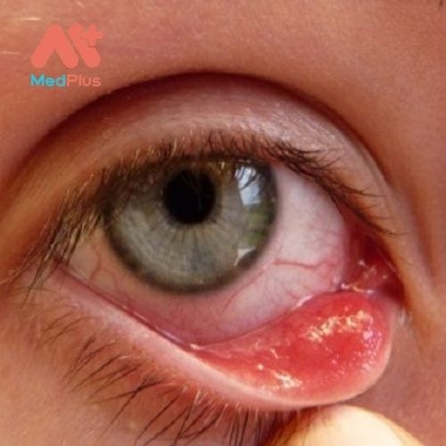 Các triệu chứng gây ra đau mắt hột