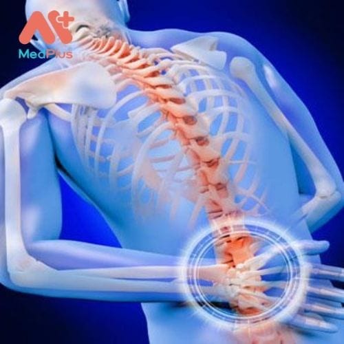 Đau lưng là tình trạng người bệnh thường xuyên xuất hiện các cơn đau ê nhức