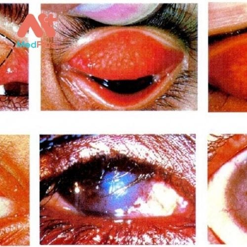 Đau mắt hột là một bệnh nhiễm trùng do vi khuẩn ảnh hưởng đến mắt.