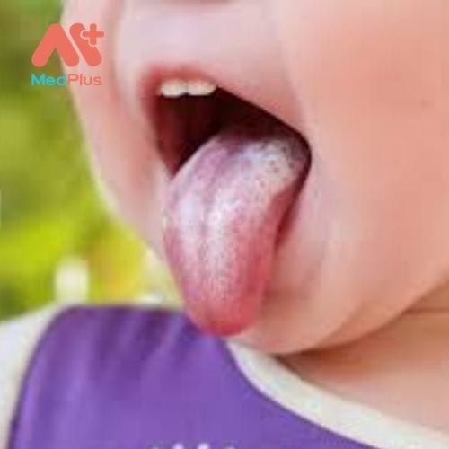 Nấm miệng là một tình trạng mà trong đó các loại nấm Candida albicans tích tụ trên niêm mạc miệng.