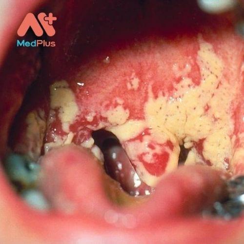 Nấm miệng là một tình trạng mà trong đó các loại nấm Candida albicans tích tụ trên niêm mạc miệng.