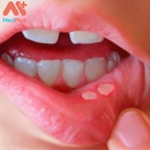 Nhiệt miệng là một căn bệnh phổ biến gặp có thể gặp ở mọi lứa tuổi.