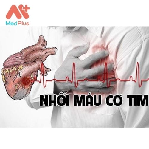 Nhồi máu cơ tim cấp là tình trạng hoại tử của cơ tim