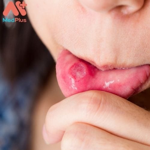 Những dấu hiệu và triệu chứng của bệnh loét miệng