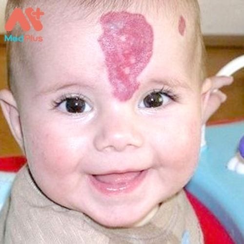 U máu ở trẻ em đa phần được phát hiện khi nổi rõ trên da gây mất thẩm mỹ