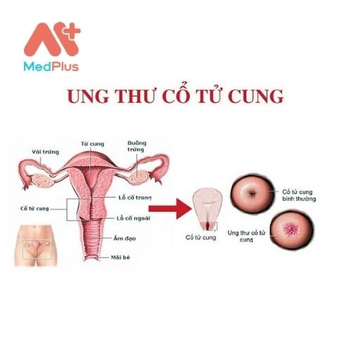 Cổ tử cung là sự phát triển bất thường của các tế bào trên cổ tử cung của phụ nữ