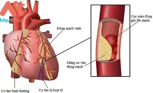 Các triệu chứng bệnh động mạch vành