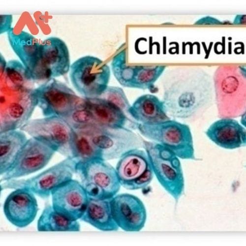 Nguyên nhân nhiễm Chlamydia