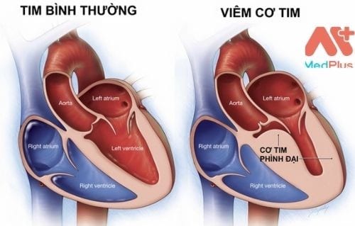Viêm cơ tim có thật sự nguy hiểm không ? Dấu hiệu cảnh báo 130 Qúa trình bị bệnh viêm cơ tim