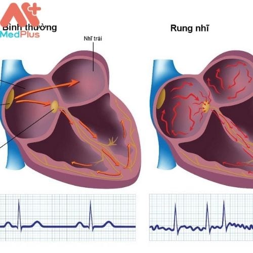 Rung nhĩ là hiện tượng rối loạn nhịp tim