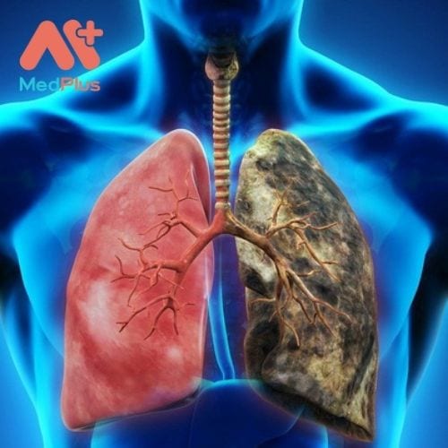Viêm màng phổi có thể xuất hiện ở rất nhiều đối tượng không phân biệt giới tính và lứa tuổi.