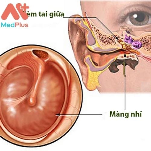 Viêm tai giữa là một trong những căn bệnh phổ biến, thường gặp trong số những bệnh lý về tai.