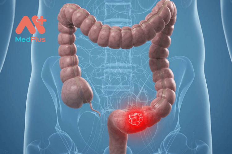 tổng quan về bệnh Crohn