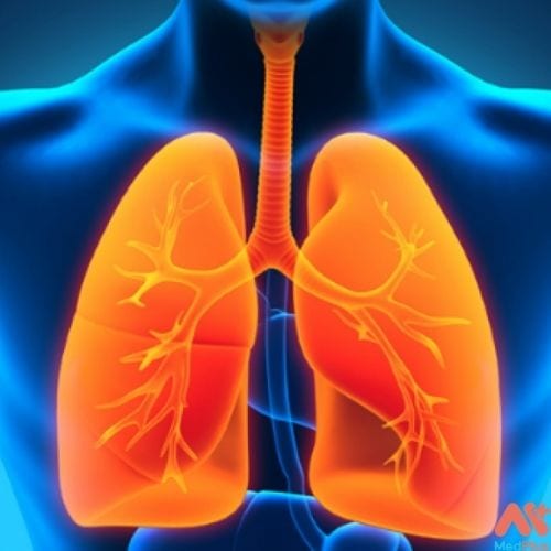 Dấu hiệu của bệnh xơ phổi