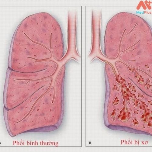 Xơ phổi và nguyên nhân gây bệnh xơ phổi