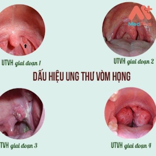 Nguyên nhân gây ra bệnh Ung thư vòm họng bạn cần biết 130 Các giai đoạn của ung thư vòm họng