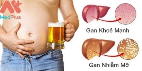 Nguyên nhân gây ra bệnh gan nhiễm mỡ