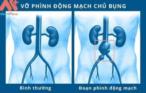 Nguyên nhân gây ra phình động mạch chủ