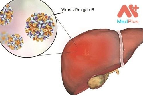 Nhiễm trùng viêm gan B là do vi rút viêm gan B.