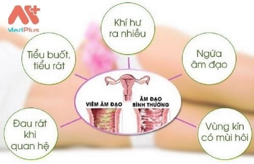 Dấu hiệu bệnh viêm âm đạo ở nữ giới