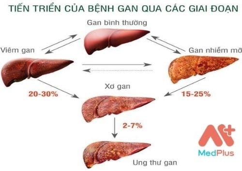 Từng giai đoạn dẫn đến bị bệnh gan nhiễm mỡ