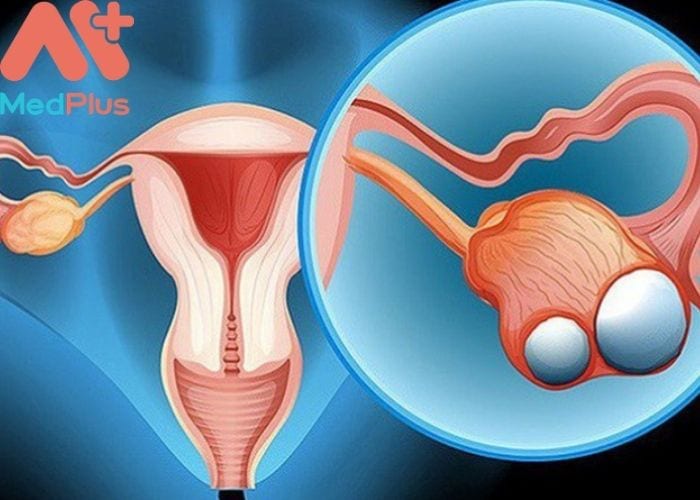 Ung thư buồng trứng là một trong những bệnh ung thư sinh dục thường gặp nhất ở nữ giới, chỉ đứng sau ung thư cổ tử cung.