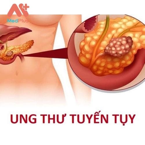 Ung thư tuyến tụy là một trong các căn bệnh nguy hiểm liên quan đến tuyến tụy.