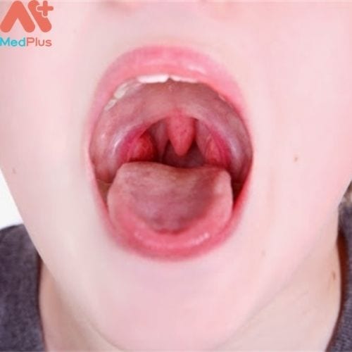 Ung thư vòm họng xảy ra khi các tế bào trong cổ họng bị đột biến gen.