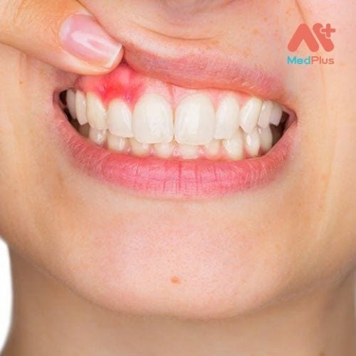 Viêm nướu là một dạng bệnh nướu răng phổ biến và nhẹ (bệnh nha chu), gây kích ứng, đỏ và sưng (viêm) phần nướu bao quanh chân răng.
