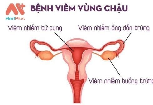 Viêm vùng chậu là tình trạng nhiễm trùng ở cơ quan sinh sản của nữ giới.