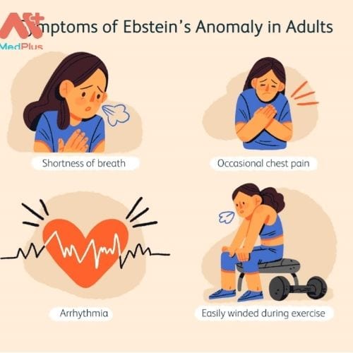 Các triệu chứng dị thường của Ebstein