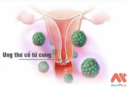 Dấu hiệu cảnh báo ung thư cổ tử cung