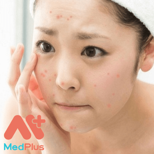 Điều trị mụn hiệu quả cao