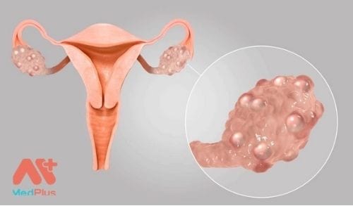 Hội chứng buồng trứng đa nang là một bệnh rối loạn nội tiết tố thường gặp ở phụ nữ trong độ tuổi sinh sản.