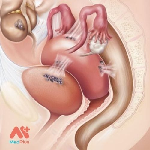 Lạc nội mạc tử cung là một căn bệnh gây ra nhiều biến chứng cho sức khỏe sinh sản và sinh lý của phụ nữ.