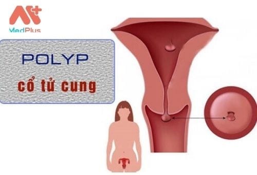 Polyp cổ tử cung là những khối u phát triển trên ống cổ tử cung, đoạn nối tử cung với âm đạo.