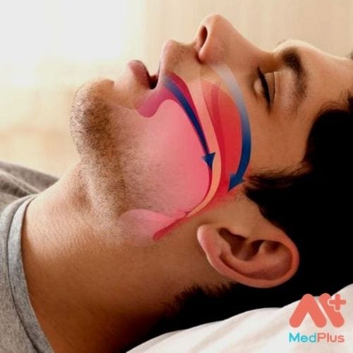 Ngừng thở khi ngủ có nguy hiểm không